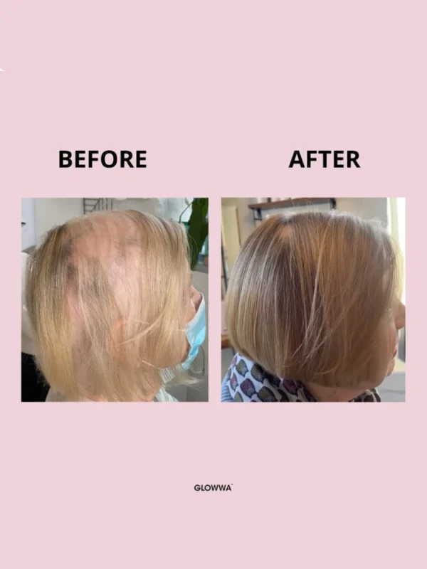 Before and after hair growth transformation