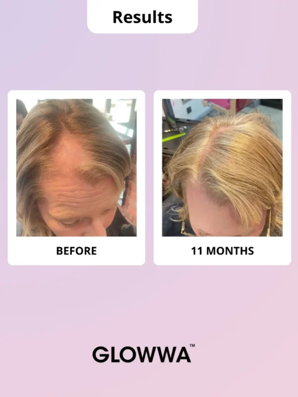 Hair growth results before and after 11 months