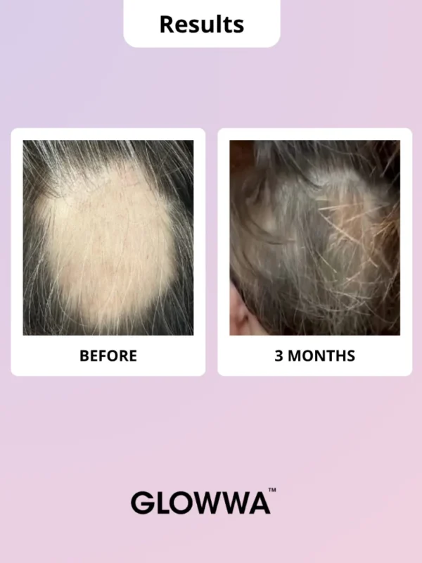 Hair regrowth results before and after three months